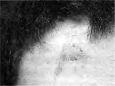 Гипертрофический рубец на коже лба